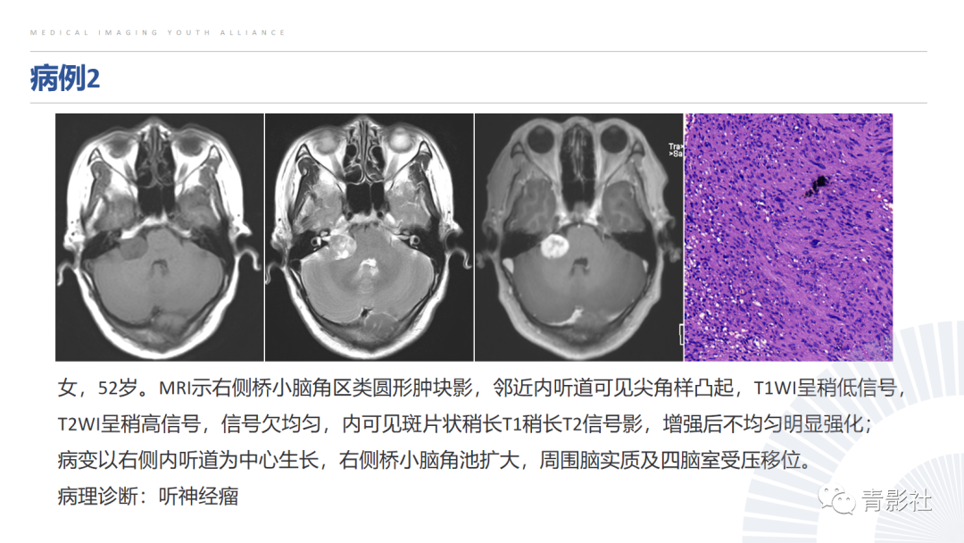 影像PPT - 【PPT】桥小脑角区肿瘤的影像诊断-8