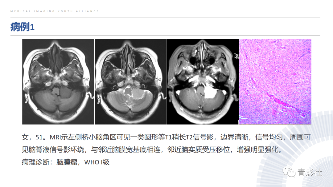 影像PPT - 【PPT】桥小脑角区肿瘤的影像诊断-11