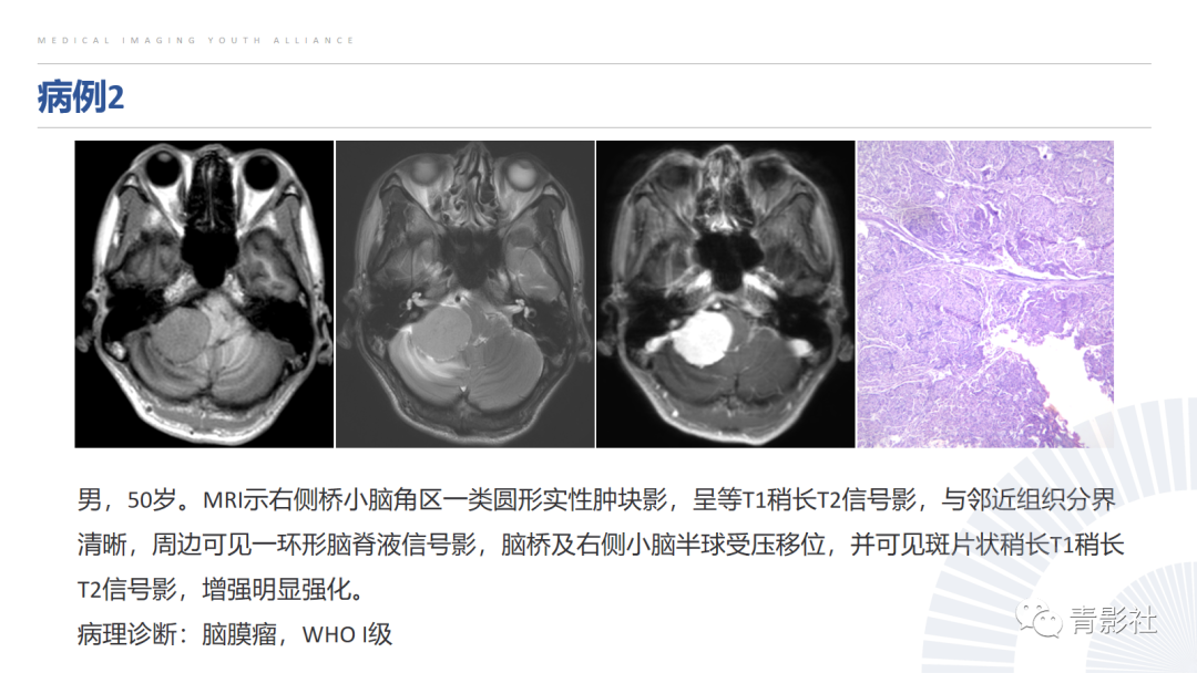 影像PPT - 【PPT】桥小脑角区肿瘤的影像诊断-12