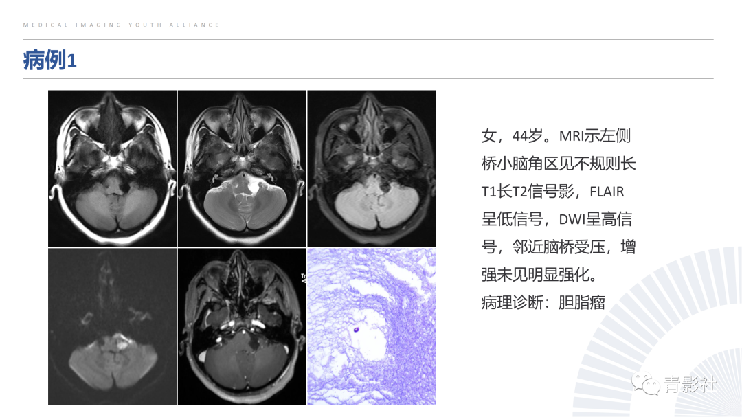 影像PPT - 【PPT】桥小脑角区肿瘤的影像诊断-15