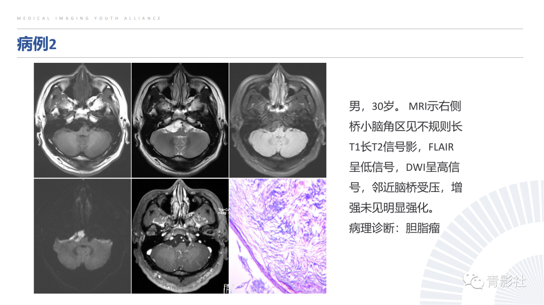 影像PPT - 【PPT】桥小脑角区肿瘤的影像诊断-16