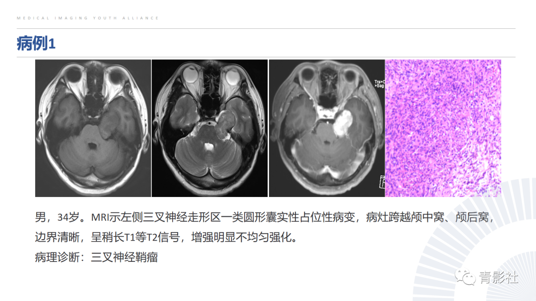 影像PPT - 【PPT】桥小脑角区肿瘤的影像诊断-19