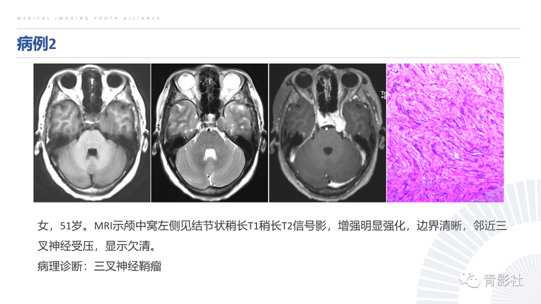 影像PPT - 【PPT】桥小脑角区肿瘤的影像诊断-20