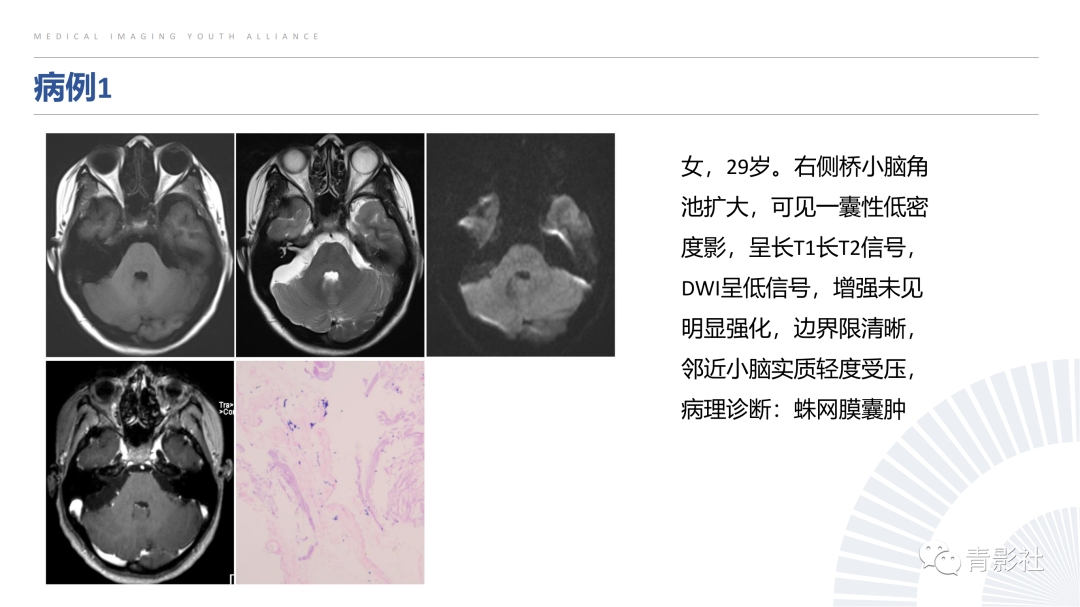 影像PPT - 【PPT】桥小脑角区肿瘤的影像诊断-24