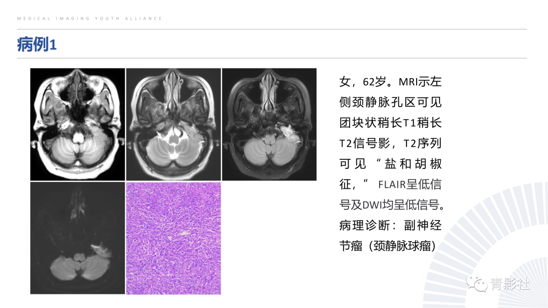 影像PPT - 【PPT】桥小脑角区肿瘤的影像诊断-27