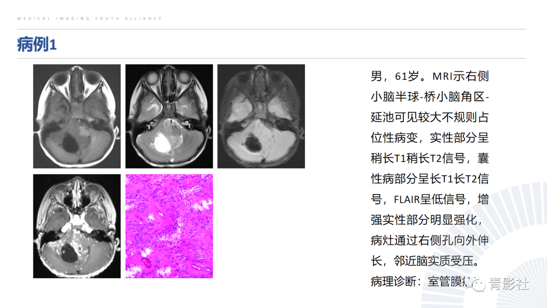 影像PPT - 【PPT】桥小脑角区肿瘤的影像诊断-33