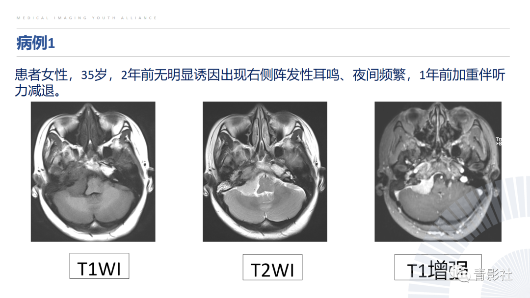 影像PPT - 【PPT】桥小脑角区肿瘤的影像诊断-41