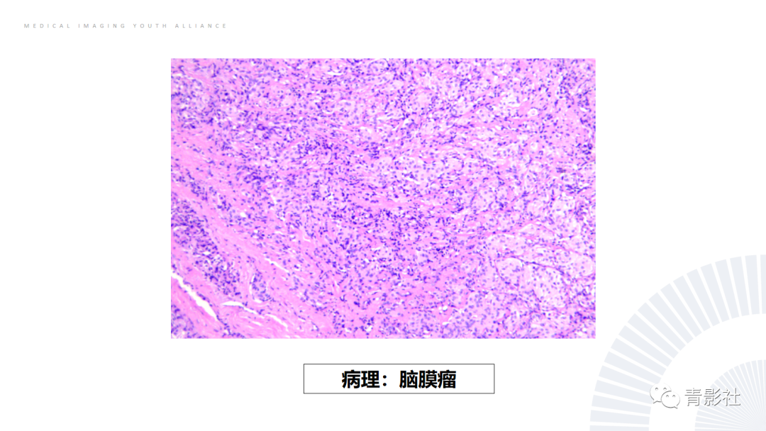 影像PPT - 【PPT】桥小脑角区肿瘤的影像诊断-43