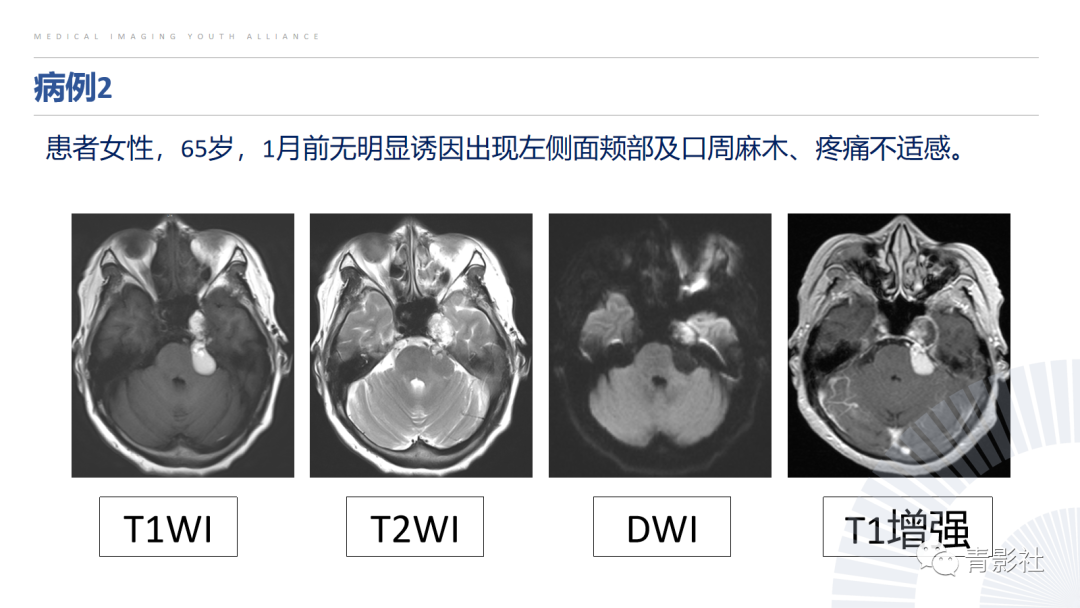影像PPT - 【PPT】桥小脑角区肿瘤的影像诊断-44