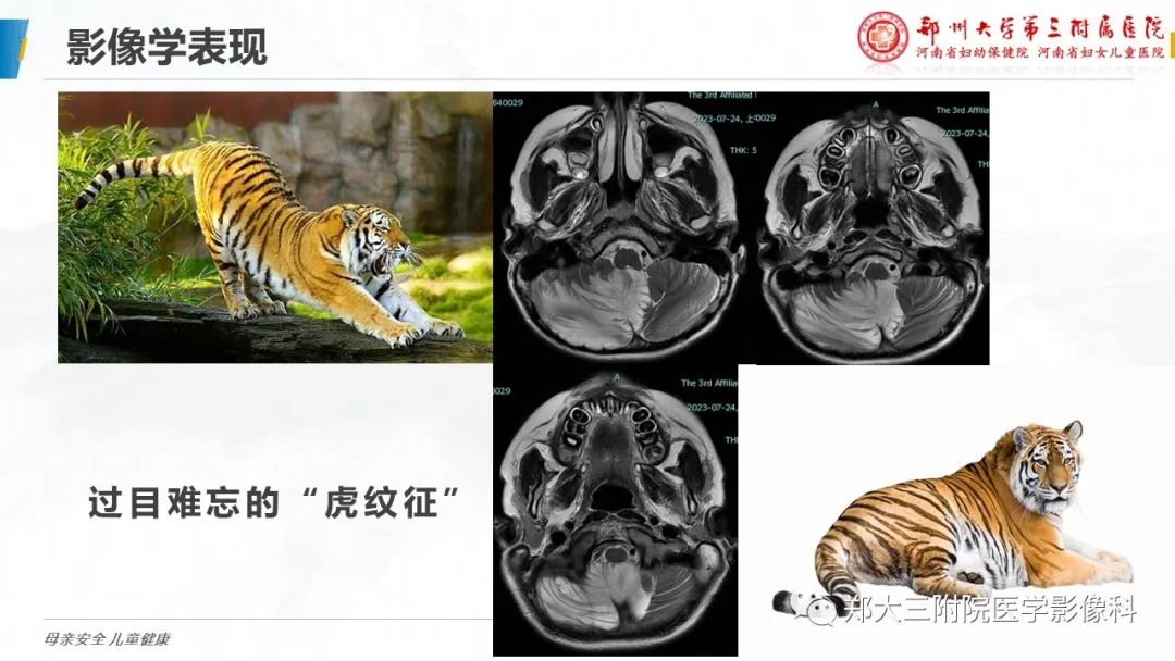 影像PPT - 【PPT】小脑发育不良性神经节细胞瘤的影像诊断-16