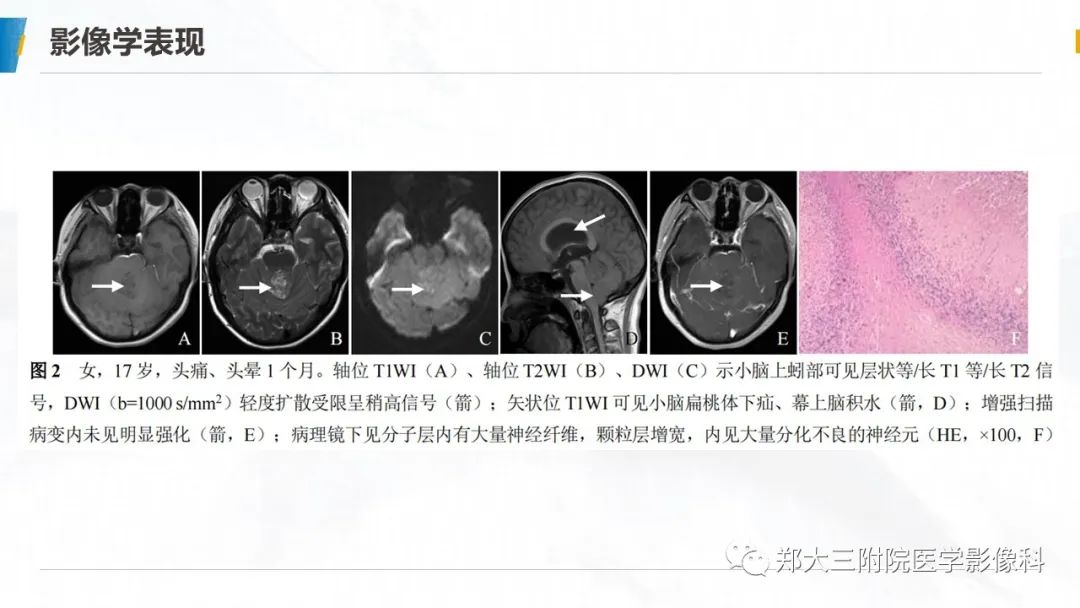 影像PPT - 【PPT】小脑发育不良性神经节细胞瘤的影像诊断-18