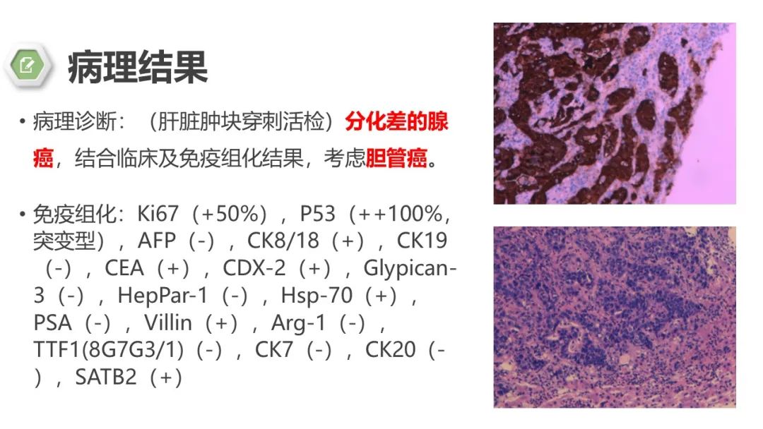 影像PPT - 【病例】肝内胆管癌1例CT及MR影像-9