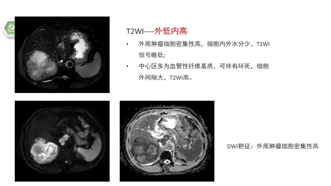 影像PPT - 【病例】肝内胆管癌1例CT及MR影像-17