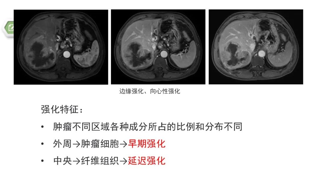 影像PPT - 【病例】肝内胆管癌1例CT及MR影像-18