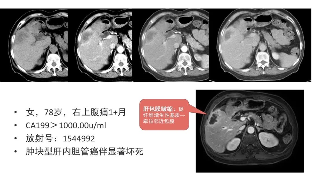 影像PPT - 【病例】肝内胆管癌1例CT及MR影像-19