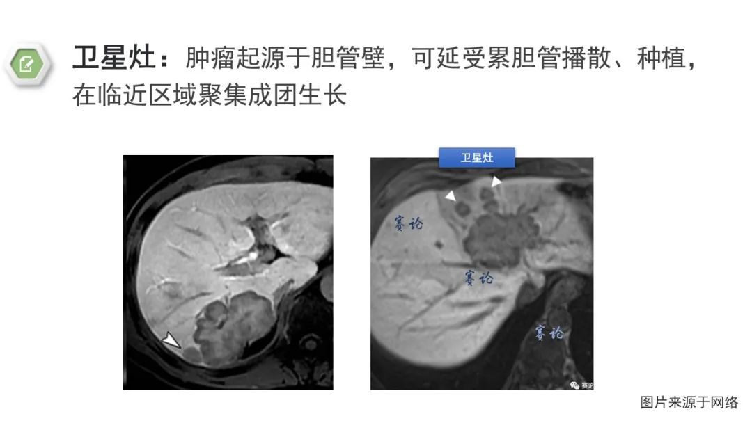 影像PPT - 【病例】肝内胆管癌1例CT及MR影像-20