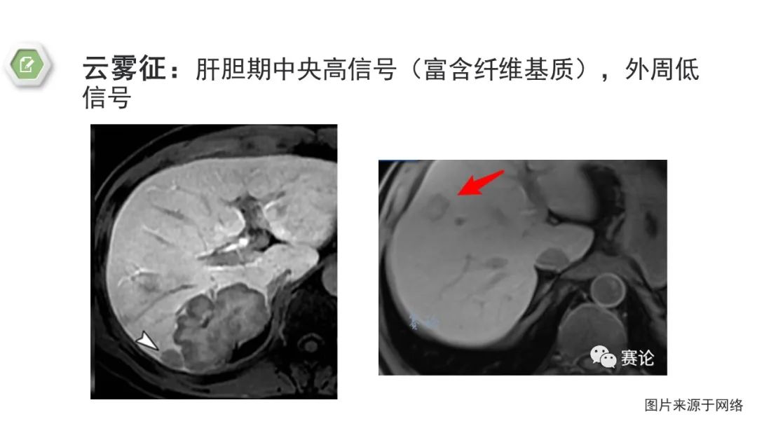 影像PPT - 【病例】肝内胆管癌1例CT及MR影像-21
