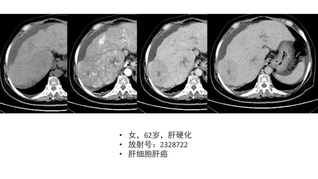 影像PPT - 【病例】肝内胆管癌1例CT及MR影像-26