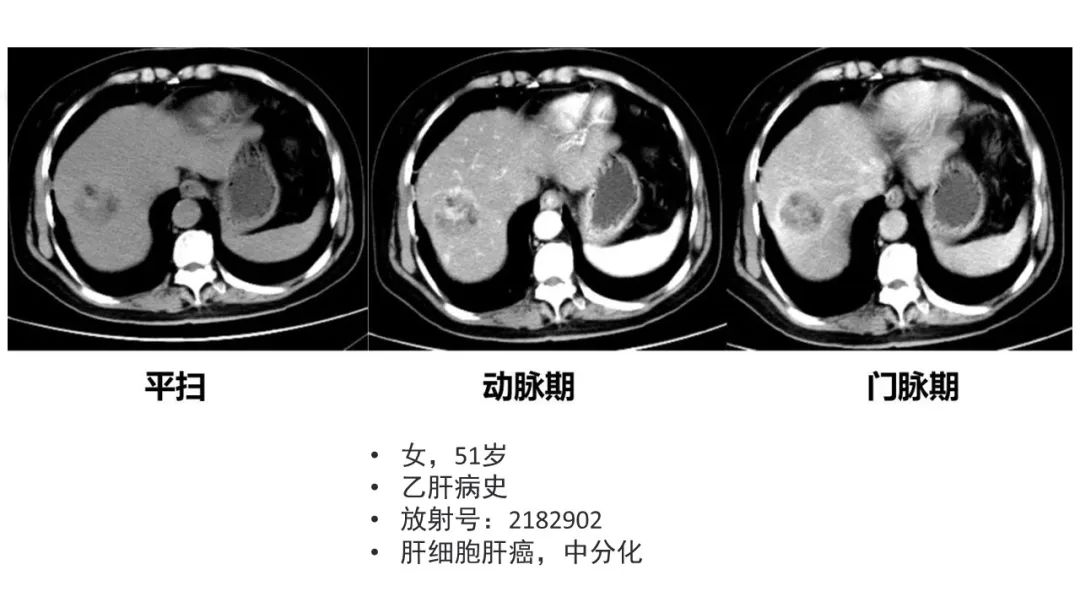 影像PPT - 【病例】肝内胆管癌1例CT及MR影像-27