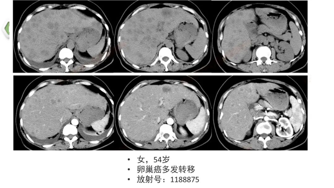 影像PPT - 【病例】肝内胆管癌1例CT及MR影像-29