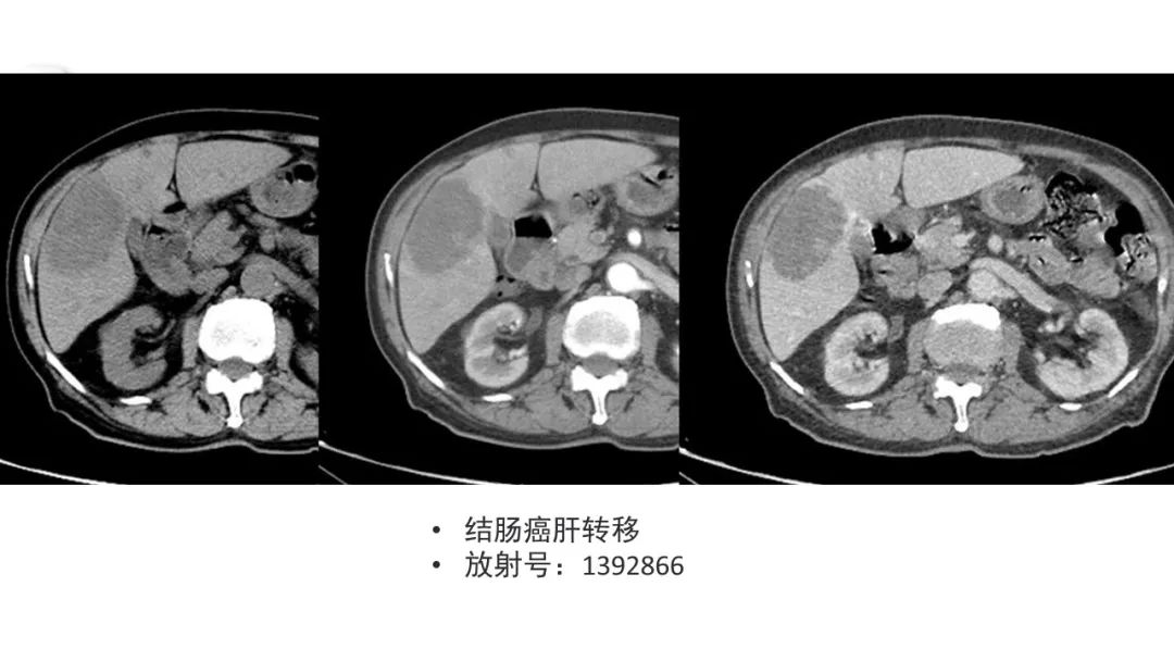 影像PPT - 【病例】肝内胆管癌1例CT及MR影像-30