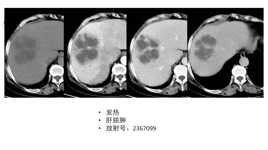 影像PPT - 【病例】肝内胆管癌1例CT及MR影像-34
