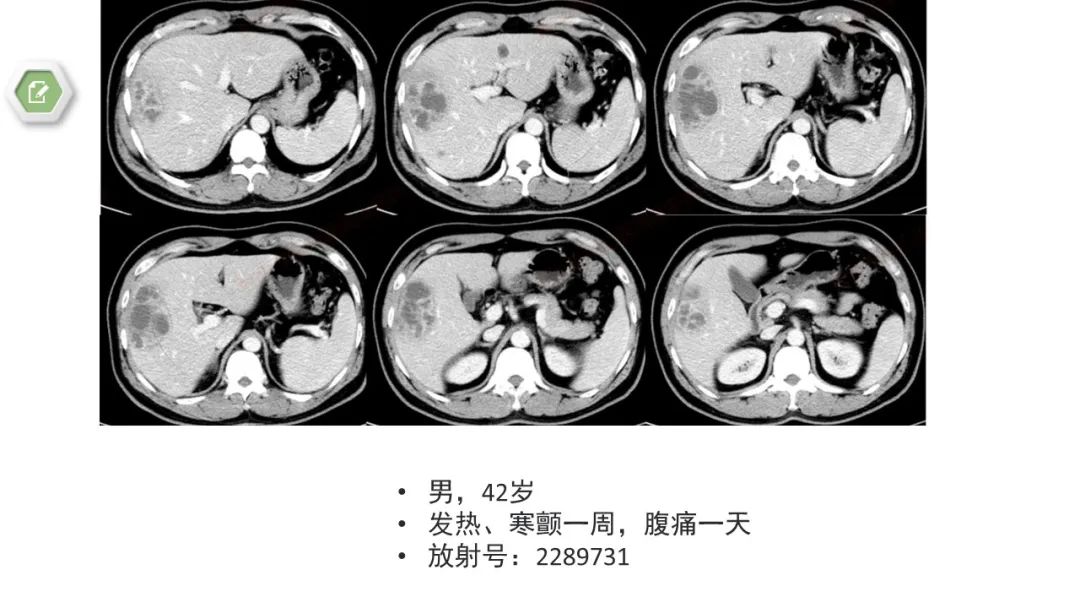 影像PPT - 【病例】肝内胆管癌1例CT及MR影像-35