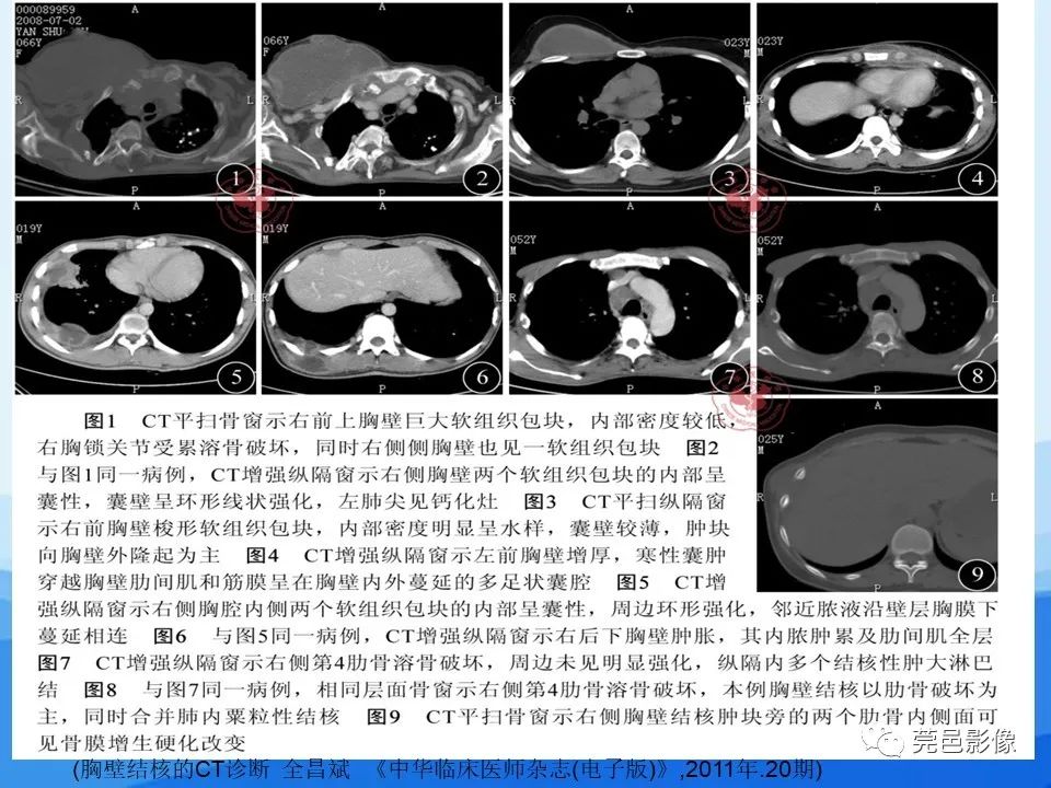 影像PPT - 【PPT】胸壁胸膜病变一例分享及文献学习-15