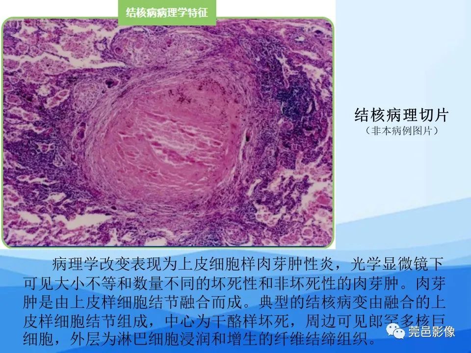 影像PPT - 【PPT】胸壁胸膜病变一例分享及文献学习-17