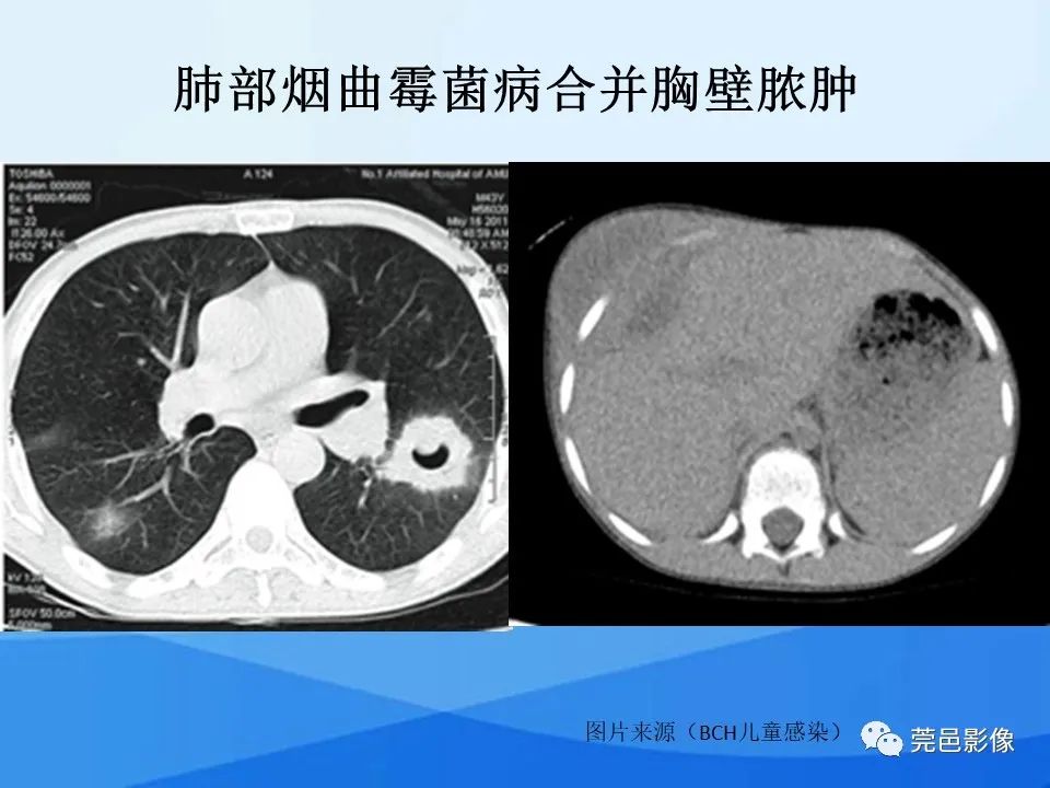影像PPT - 【PPT】胸壁胸膜病变一例分享及文献学习-19
