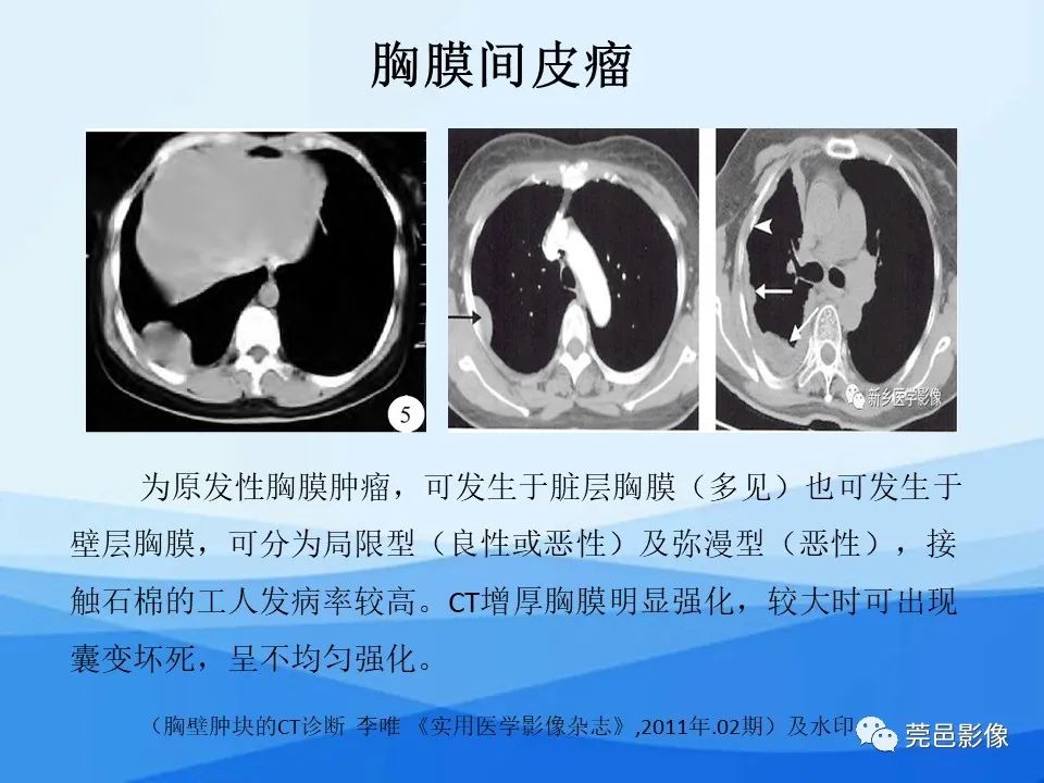 影像PPT - 【PPT】胸壁胸膜病变一例分享及文献学习-21