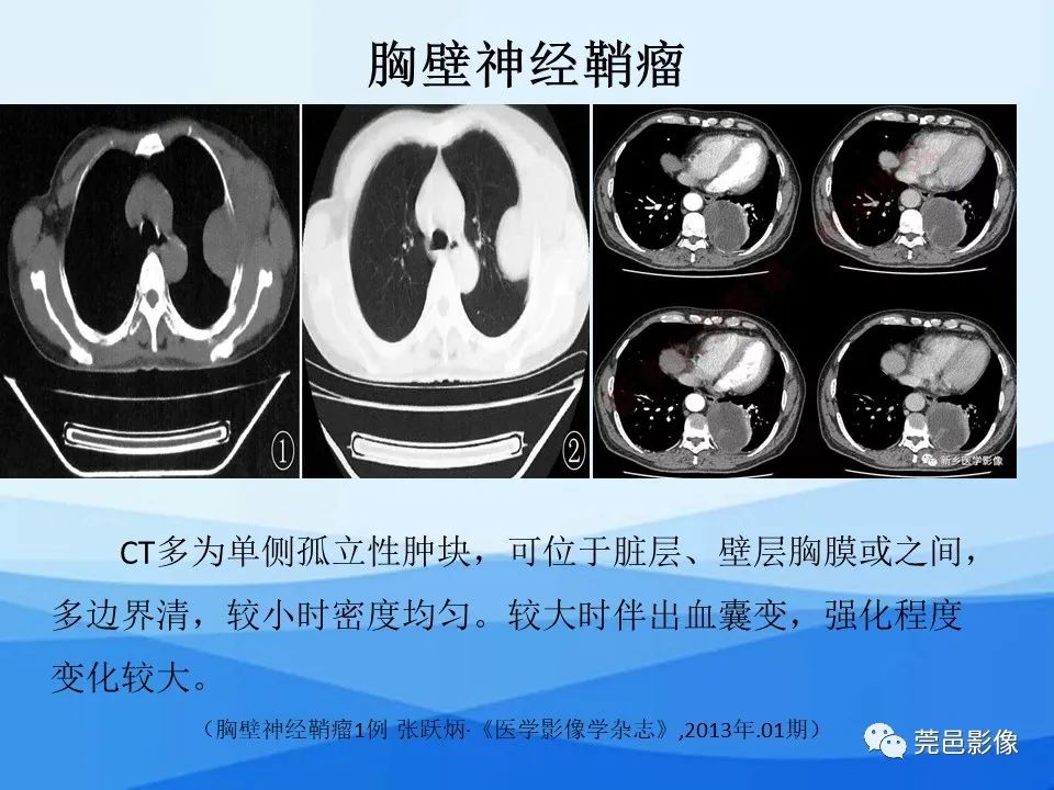 影像PPT - 【PPT】胸壁胸膜病变一例分享及文献学习-22