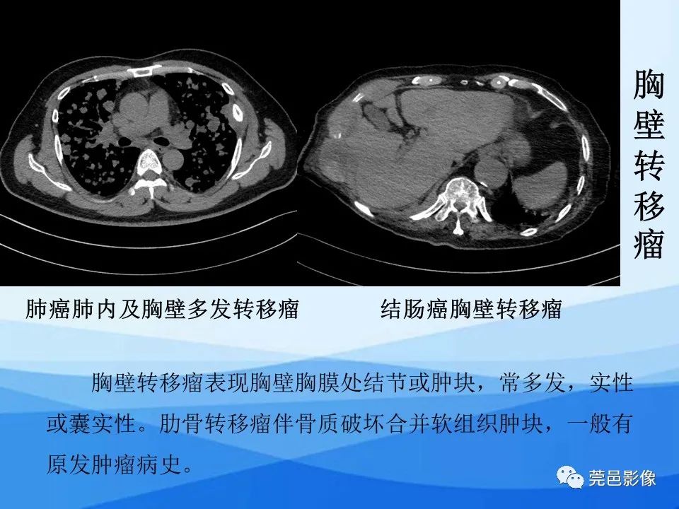 影像PPT - 【PPT】胸壁胸膜病变一例分享及文献学习-23