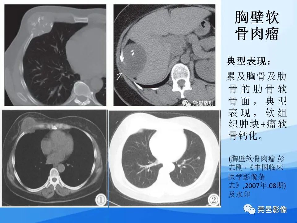 影像PPT - 【PPT】胸壁胸膜病变一例分享及文献学习-25