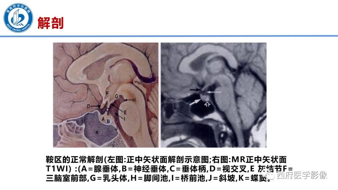 影像PPT - 【病例】鞍区囊性颅咽管瘤1例CT及MR影像诊断与鉴别-2
