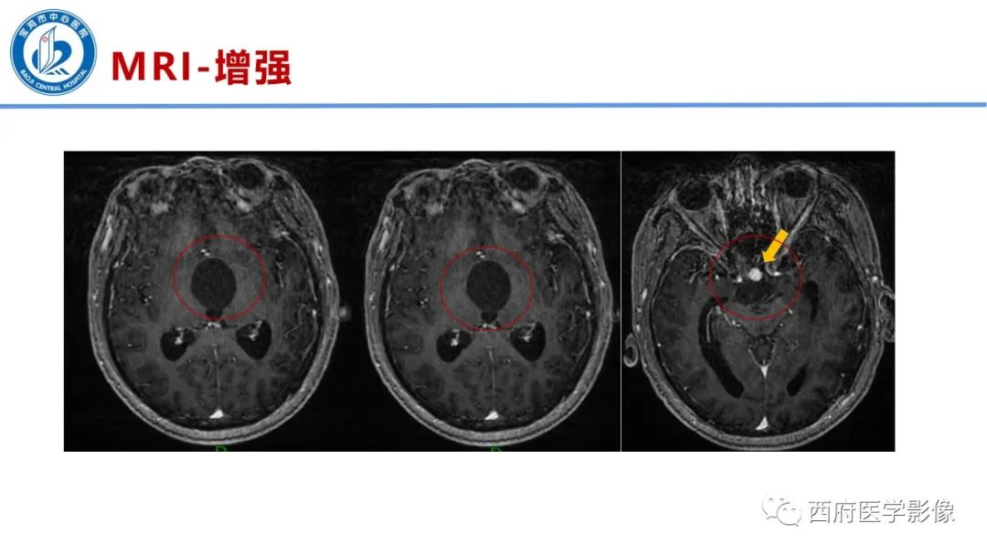 影像PPT - 【病例】鞍区囊性颅咽管瘤1例CT及MR影像诊断与鉴别-10