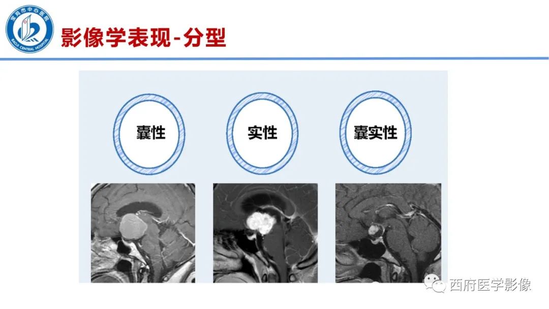 影像PPT - 【病例】鞍区囊性颅咽管瘤1例CT及MR影像诊断与鉴别-21