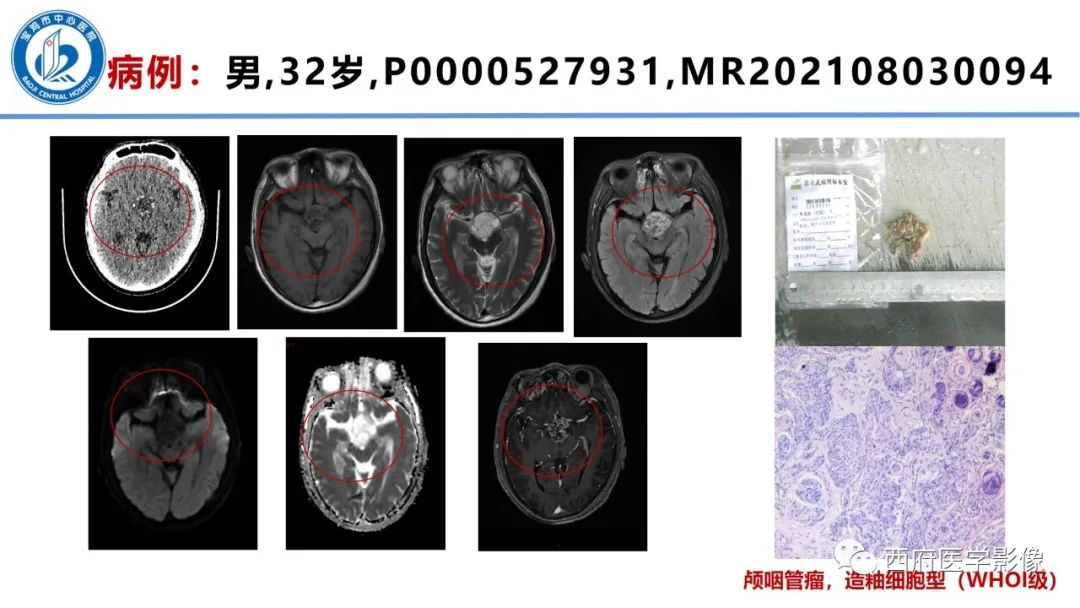影像PPT - 【病例】鞍区囊性颅咽管瘤1例CT及MR影像诊断与鉴别-25