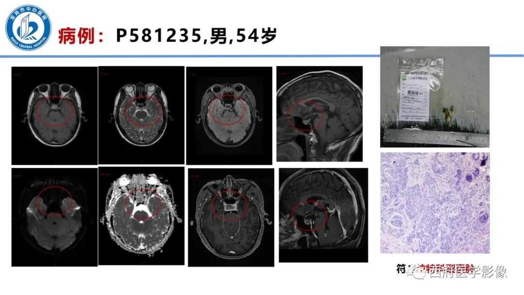 影像PPT - 【病例】鞍区囊性颅咽管瘤1例CT及MR影像诊断与鉴别-30