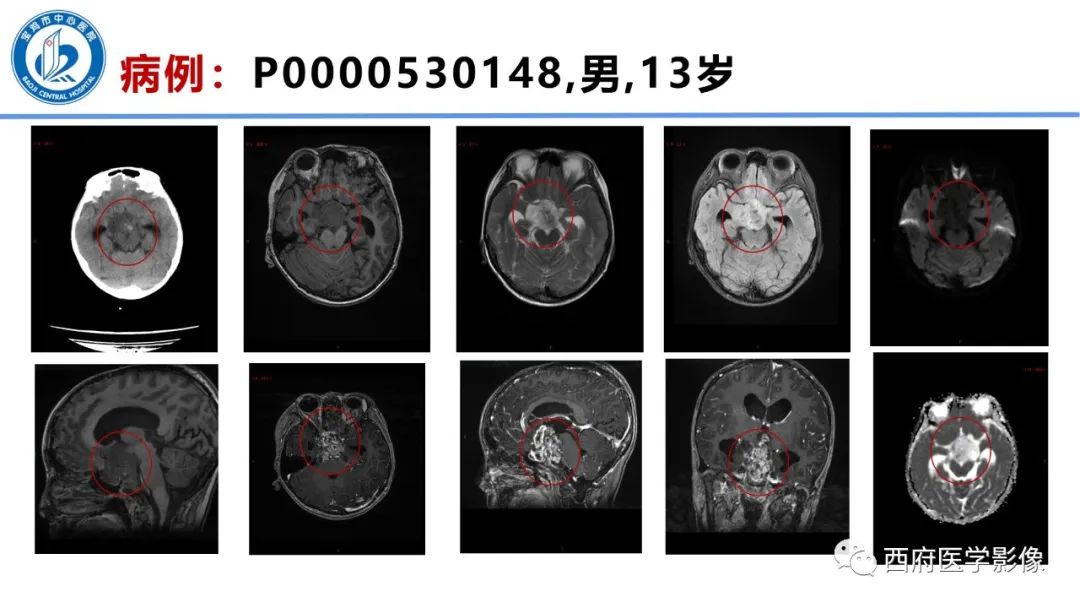 影像PPT - 【病例】鞍区囊性颅咽管瘤1例CT及MR影像诊断与鉴别-35