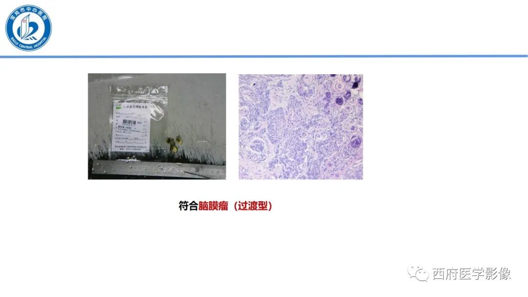 影像PPT - 【病例】鞍区囊性颅咽管瘤1例CT及MR影像诊断与鉴别-33
