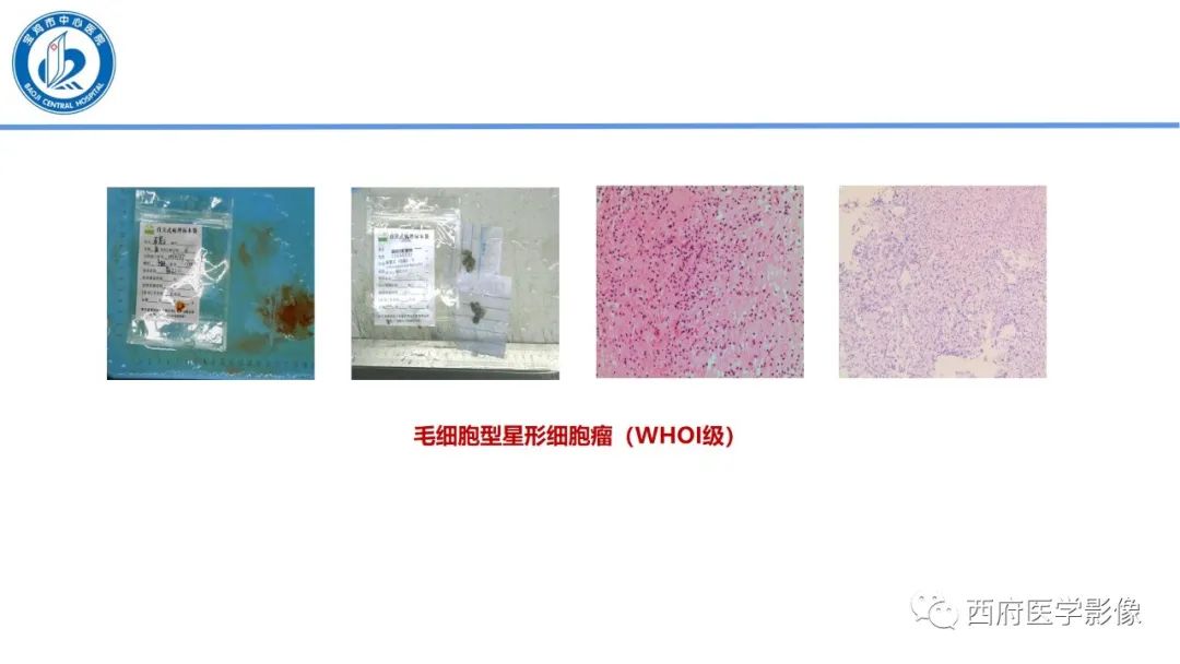 影像PPT - 【病例】鞍区囊性颅咽管瘤1例CT及MR影像诊断与鉴别-36