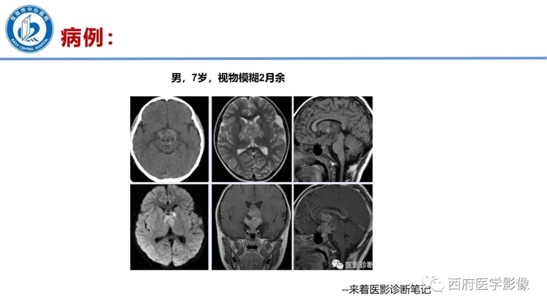 影像PPT - 【病例】鞍区囊性颅咽管瘤1例CT及MR影像诊断与鉴别-38