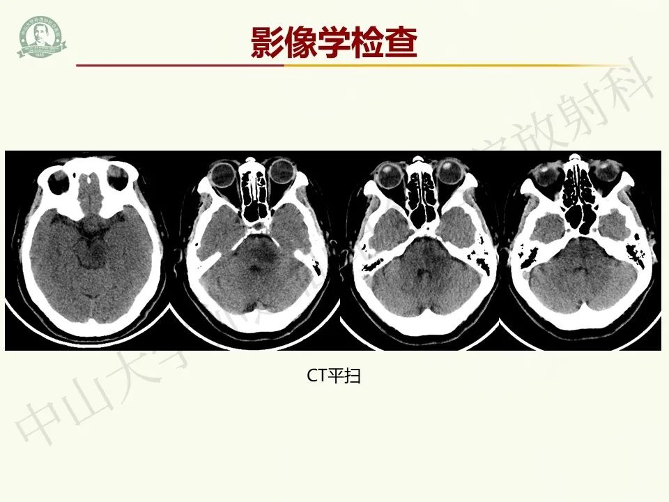 影像PPT - 【病例】脑干脱髓鞘假瘤1例CT及MR影像-3
