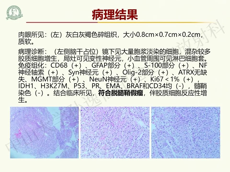 影像PPT - 【病例】脑干脱髓鞘假瘤1例CT及MR影像-11