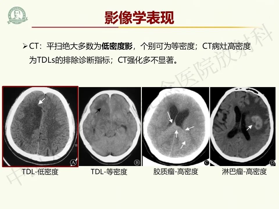 影像PPT - 【病例】脑干脱髓鞘假瘤1例CT及MR影像-14