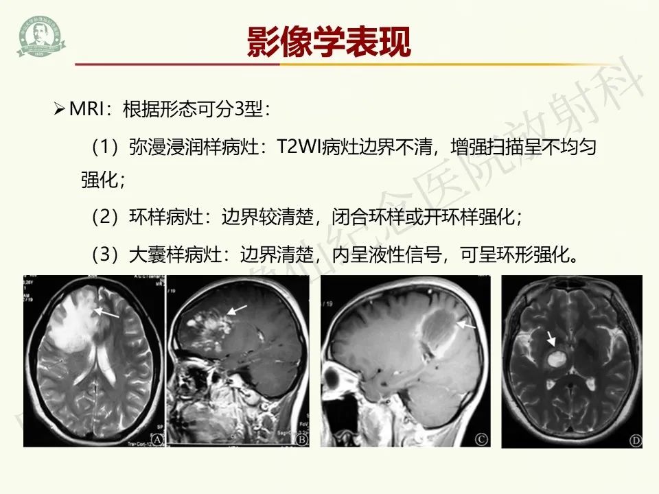 影像PPT - 【病例】脑干脱髓鞘假瘤1例CT及MR影像-15