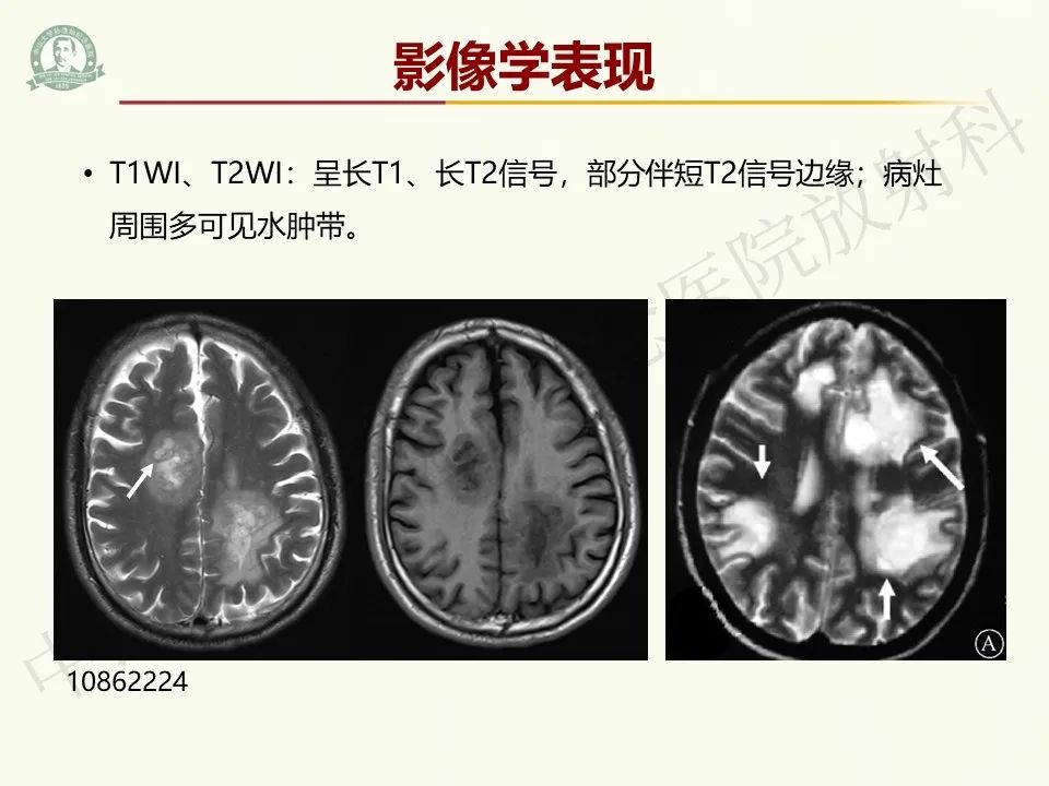 影像PPT - 【病例】脑干脱髓鞘假瘤1例CT及MR影像-16