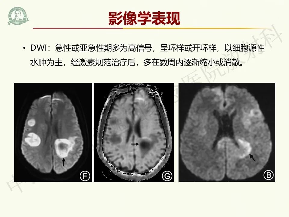 影像PPT - 【病例】脑干脱髓鞘假瘤1例CT及MR影像-17