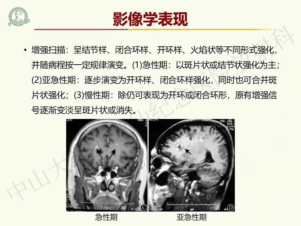 影像PPT - 【病例】脑干脱髓鞘假瘤1例CT及MR影像-18